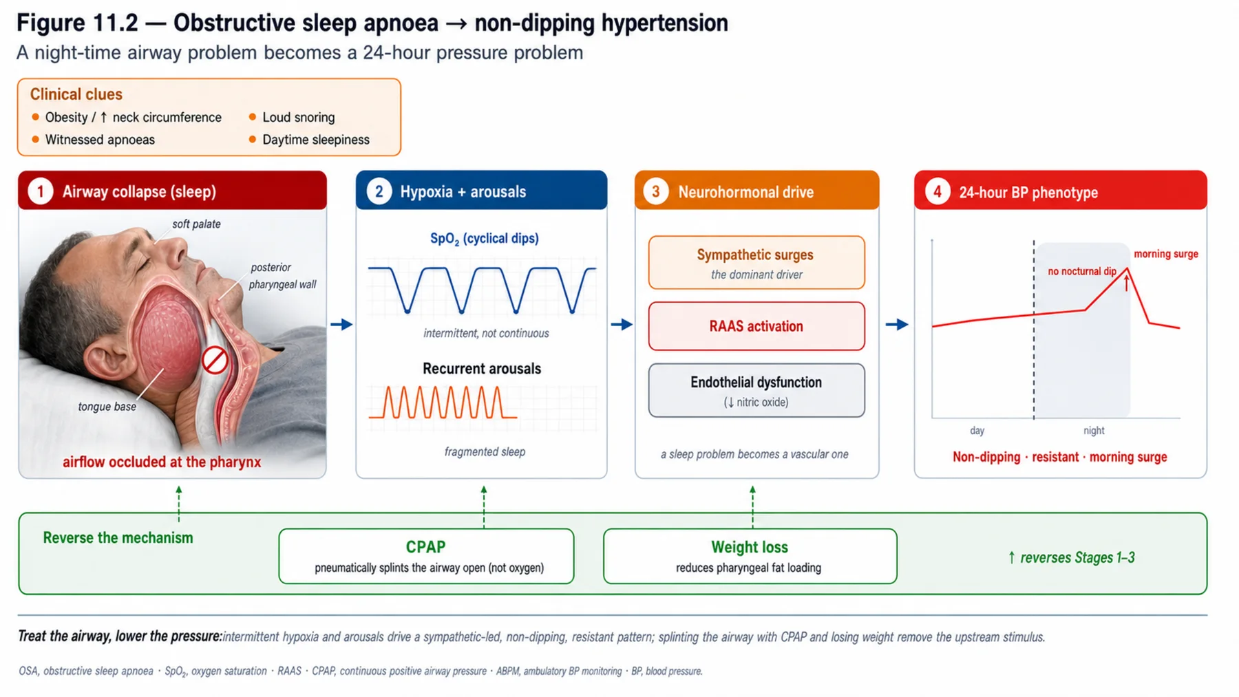 Figure 11.2 - Obstructive sleep apnoea to non-dipping hypertension