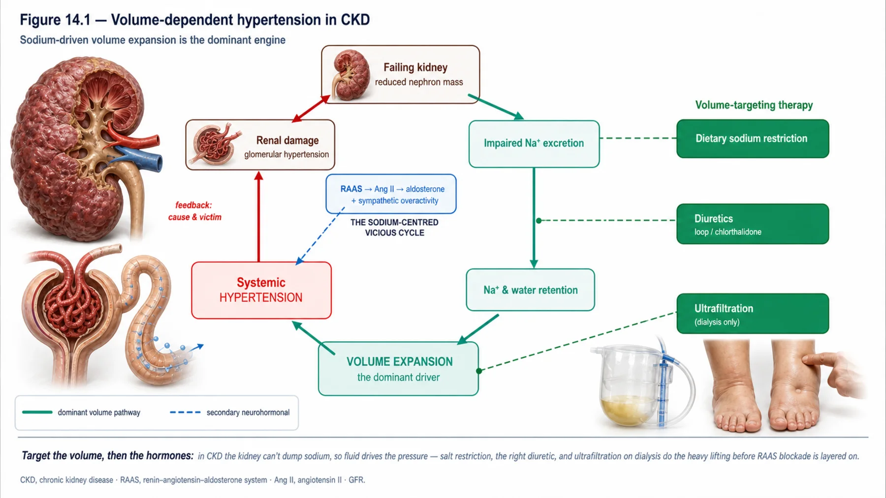 Figure 14.1 - Volume-dependent hypertension in CKD