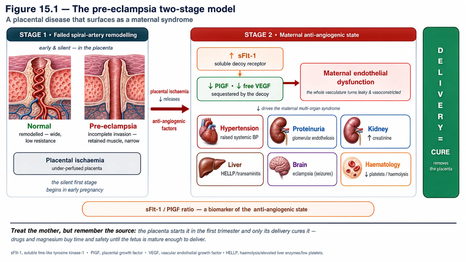 Figure 15.1 - The pre-eclampsia two-stage model