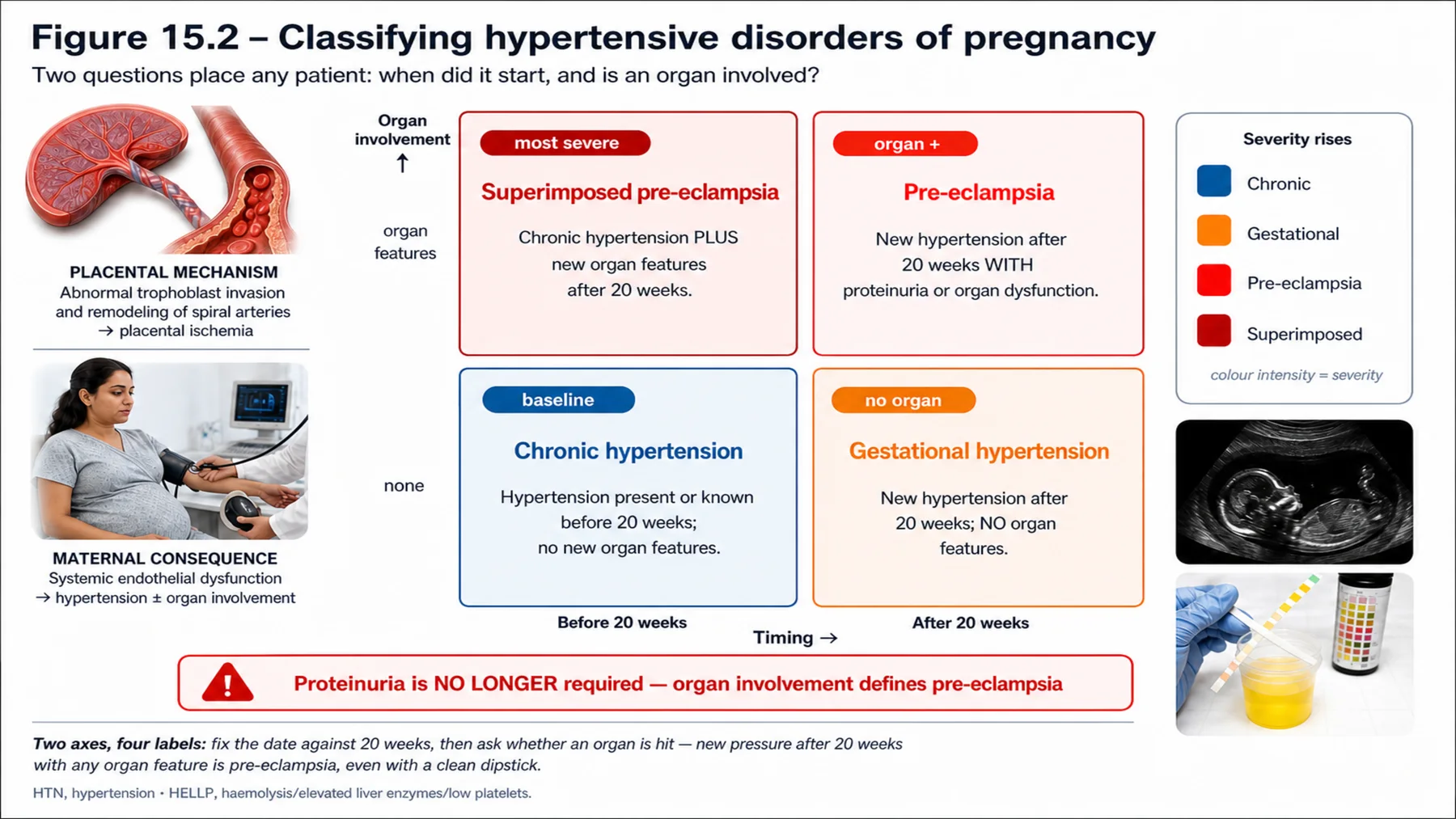 Figure 15.2 - Classifying hypertensive disorders of pregnancy