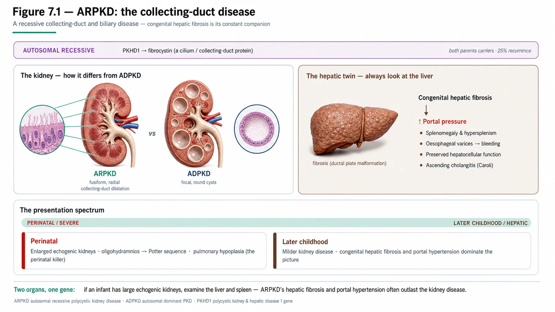 Figure 7.1 - ARPKD: the collecting-duct disease