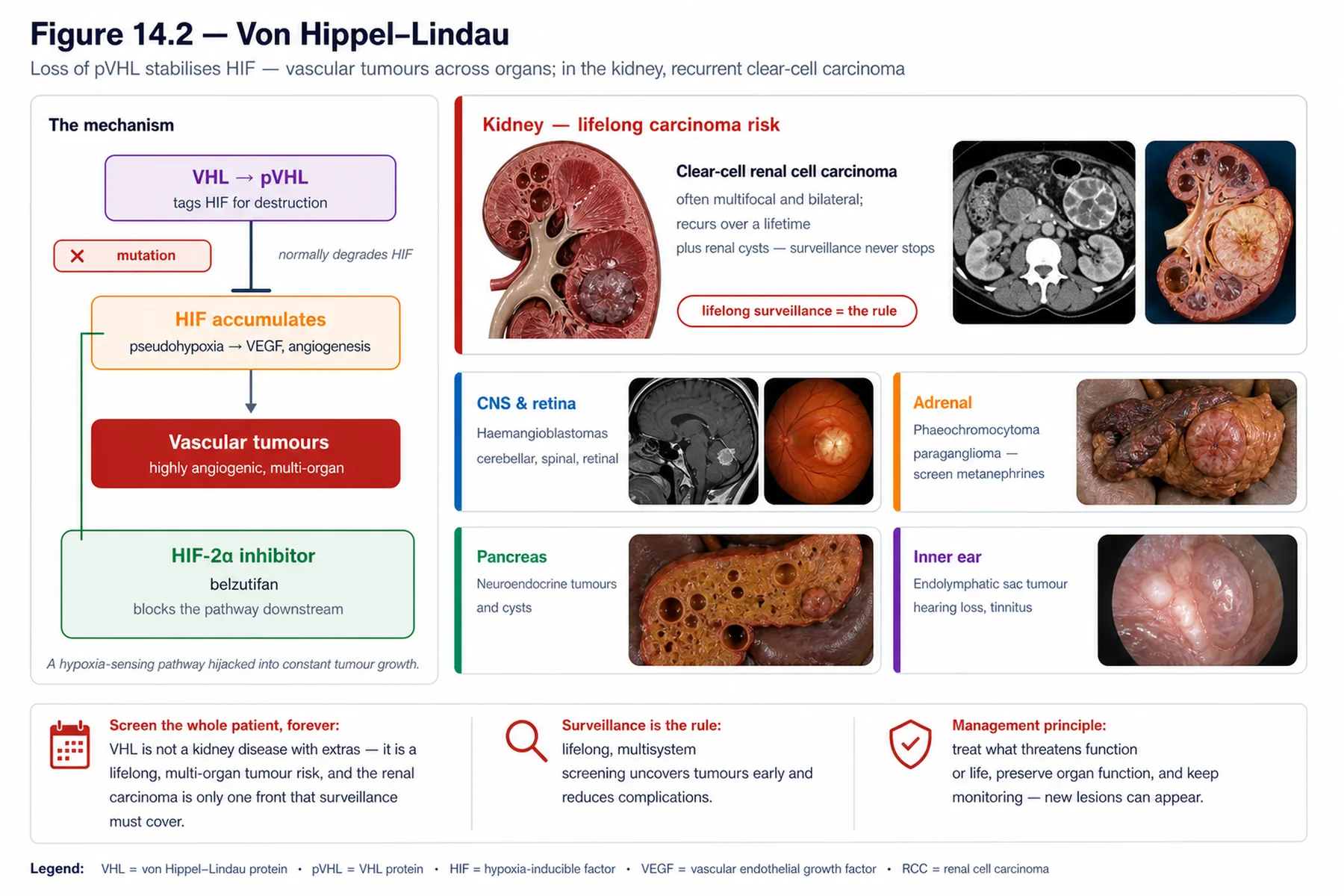 Figure 14.2 - Von Hippel–Lindau