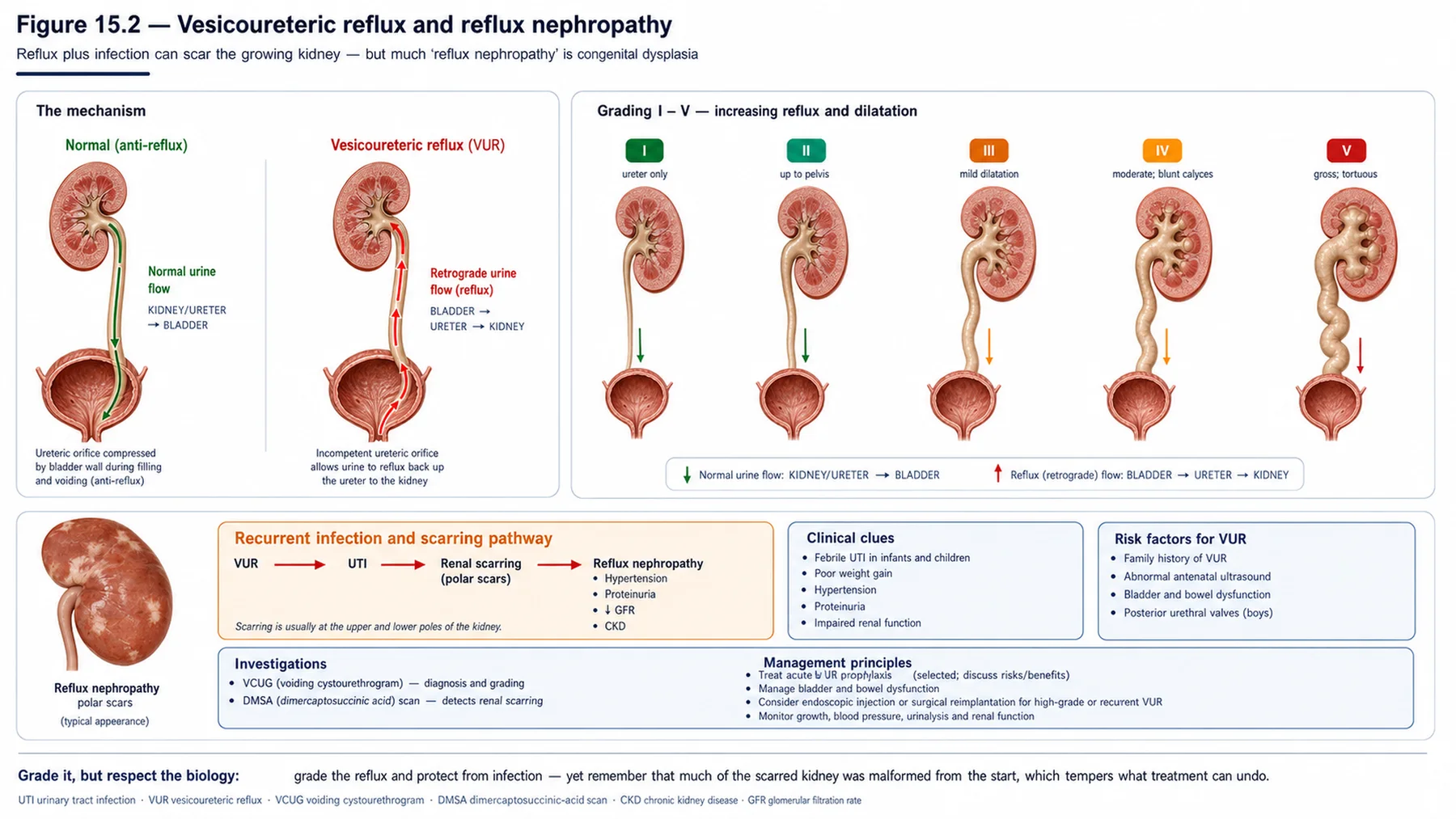 Figure 15.2 - Vesicoureteric reflux and reflux nephropathy
